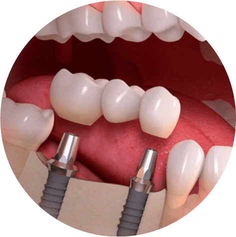 протезування зубів Хуст імпланти Хуст
